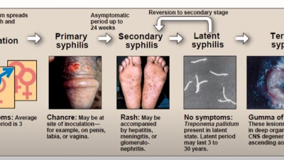 매독이 한국에서 창궐하고 있습니다